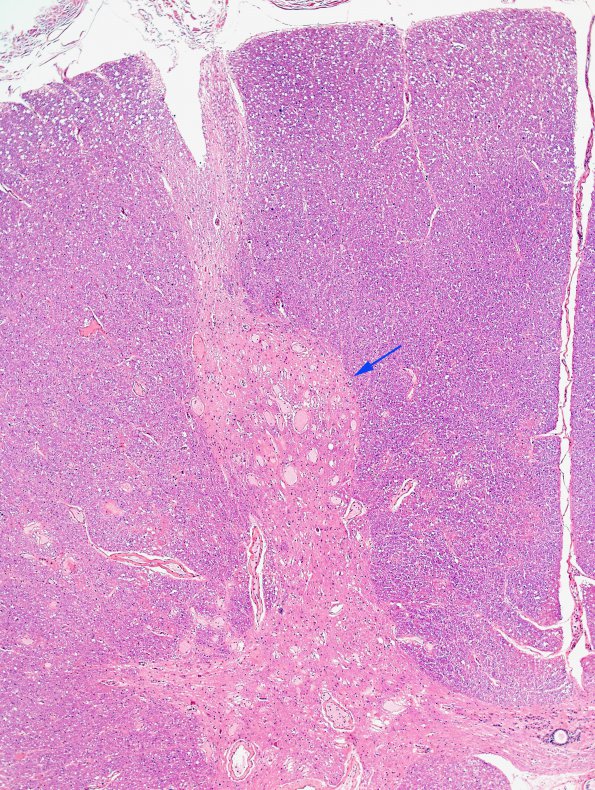 7 Telangiectases (Case 7) H&E 2 copy