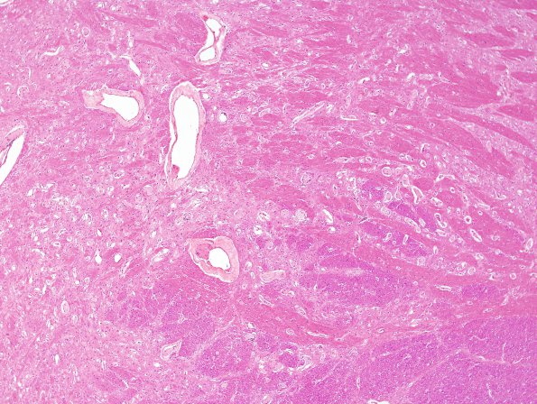 9B2 Telangiectasis (Case 9) N17 H&E 2.jpg