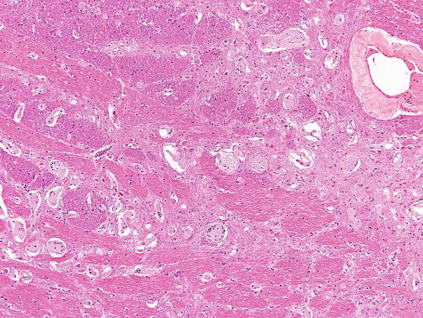 9B3 Telangiectasis (Case 9) N17 H&E 1.jpg