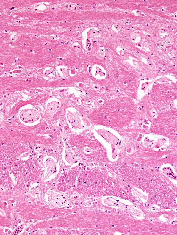 9B4 Telangiectasis (Case 9) N17 H&E 4.jpg