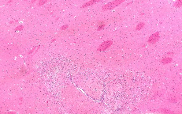 2C1 TTP (Case 2) N4 H&E infarct 4X 1