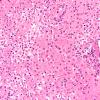 2C2 TTP (Case 2) N4 H&E infarct 2X 1