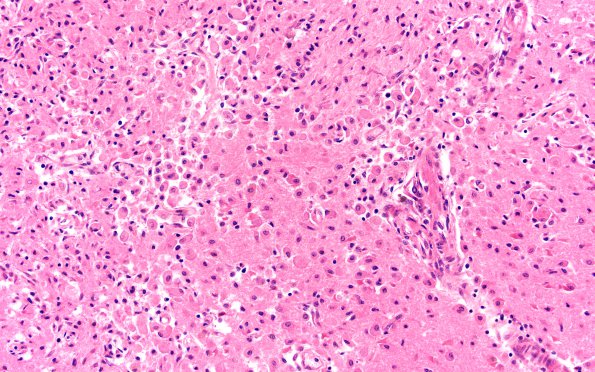 2C2 TTP (Case 2) N4 H&E infarct 2X 1