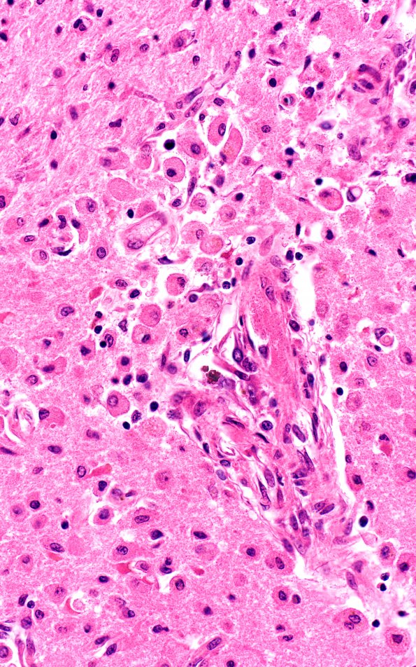 2C3 TTP (Case 2) N4 H&E infarct 40X 1