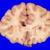 4A1 Hemorrhage,SLE, DIC, TCP (Case 4) 4