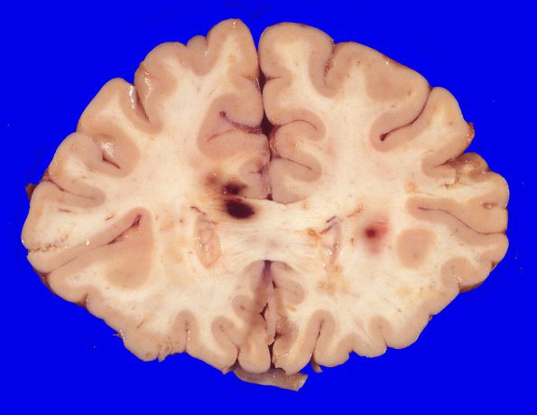 4A1 Hemorrhage,SLE, DIC, TCP (Case 4) 4