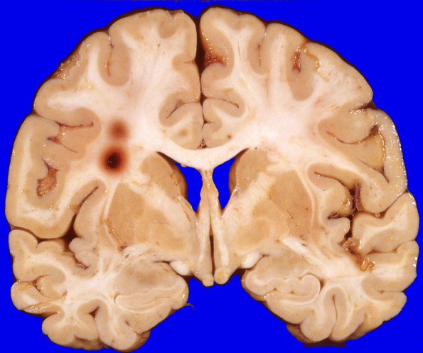 4A2 Hemorrhage,SLE, DIC, TCP (Case 4) 1