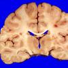 4A3 Hemorrhage,SLE, DIC, TCP (Case 4) 3