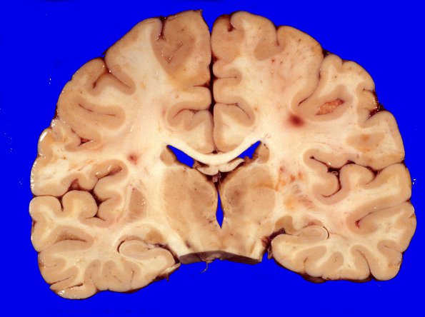 4A3 Hemorrhage,SLE, DIC, TCP (Case 4) 3