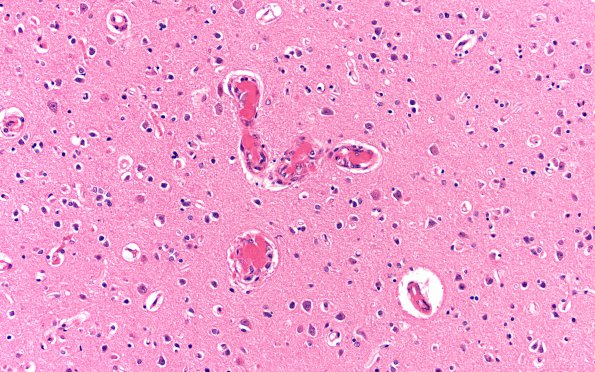 4B1 Hemorrhage,SLE, DIC, TCP (Case 4) N13 20X 1