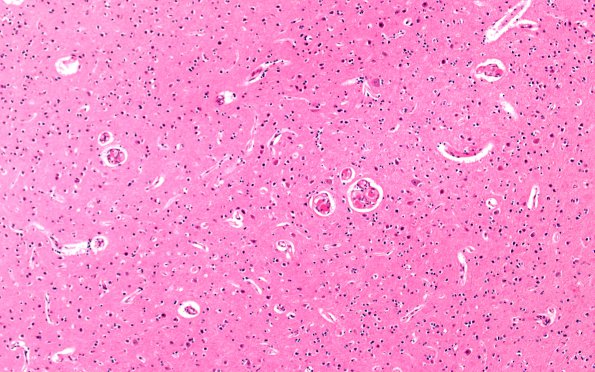 4B2 Hemorrhage,SLE, DIC, TCP (Case 4) N13 10X 1