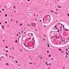 4B3 Hemorrhage,SLE, DIC, TCP (Case 4) N13 40X 1