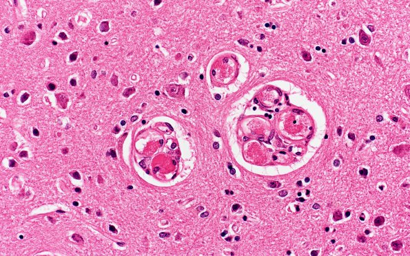 4B3 Hemorrhage,SLE, DIC, TCP (Case 4) N13 40X 1