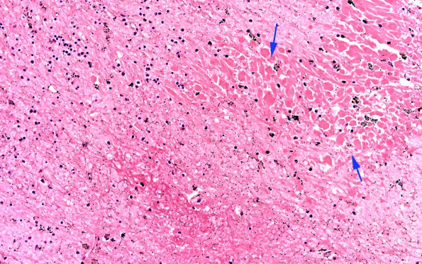 4D3 Hemorrhage,SLE, DIC, TCP (Case 4) 1N14 20X copy A