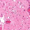 4D4 Hemorrhage,SLE, DIC, TCP (Case 4) N6 40X 1