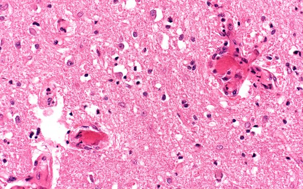 4D4 Hemorrhage,SLE, DIC, TCP (Case 4) N6 40X 1