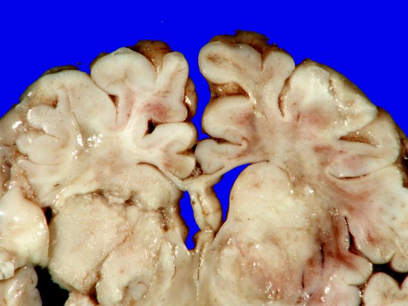 10B5 Hypoxia-Ischemia, neonatal (ulegyria) (Case 10) Gross_7B