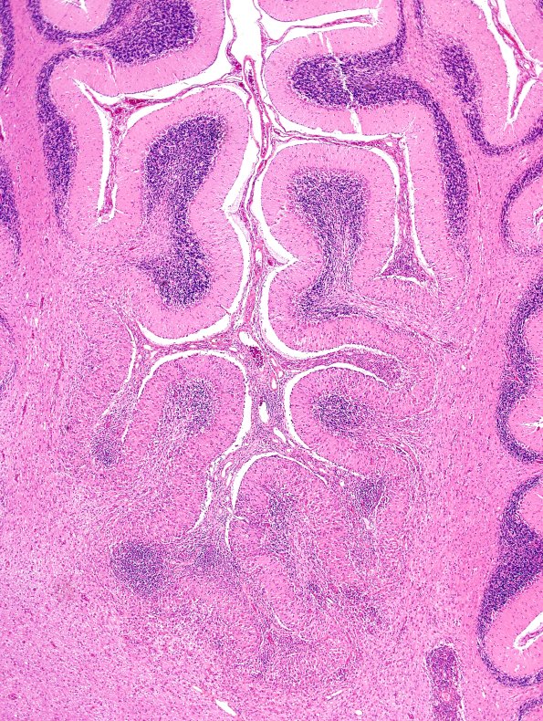 10E2 Ulegyria & PTLD (Case 10) N15 H&E 3