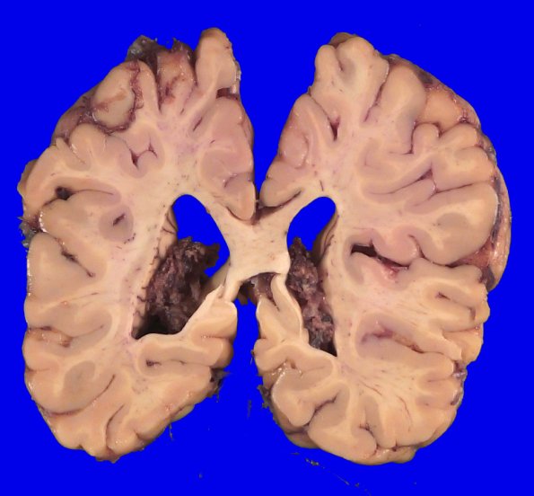 11B3 Ulegyria (Case 11)_5