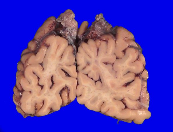 11B5 Ulegyria (Case 11)_8