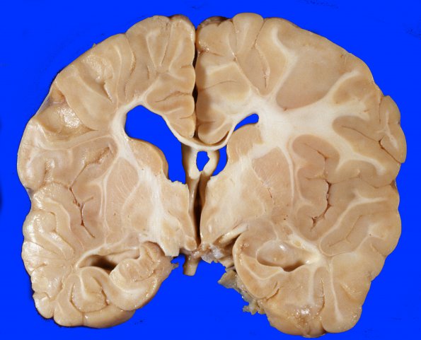 1A1 Ulegyria, perinatal insult (Case 1) 1