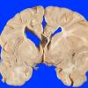 1A3 Hypoxia Ischemia, neonatal (Case 1) 1