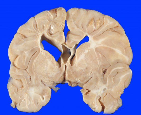 1A3 Hypoxia Ischemia, neonatal (Case 1) 1