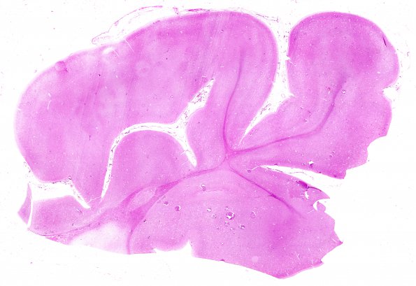 1B1 (Case 1) Ulegyria 1