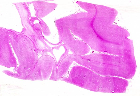 1B2 (Case 1) Ulegyria 1 H&E WM