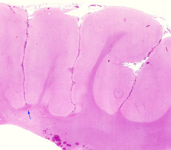 2B1 Ulegyria (Case 2) H&E WM 3 copy