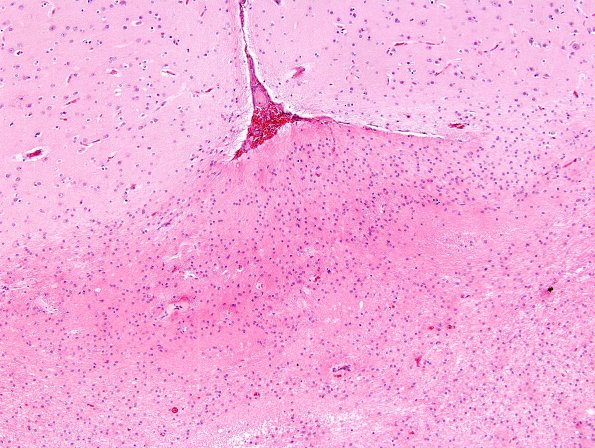 2B3 Ulegyria (Case 2) H&E 2
