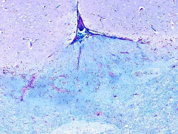 2C2 Ulegyria (Case 2) LFB-PAS 2