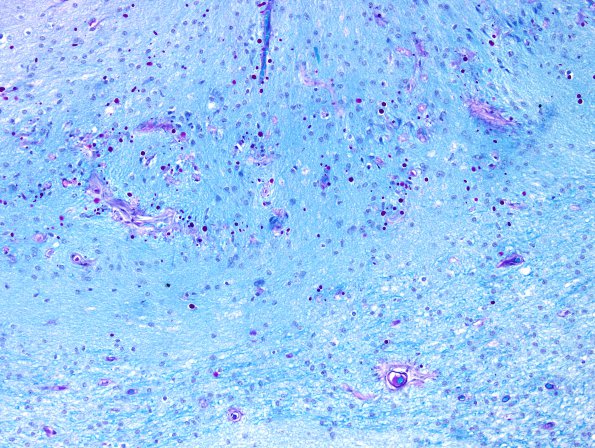 2C3 Ulegyria (Case 2) LFB-PAS 1