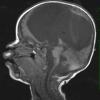 3A1 Ulegyria (Case 3) later than MRI 1 T1 3 - Copy