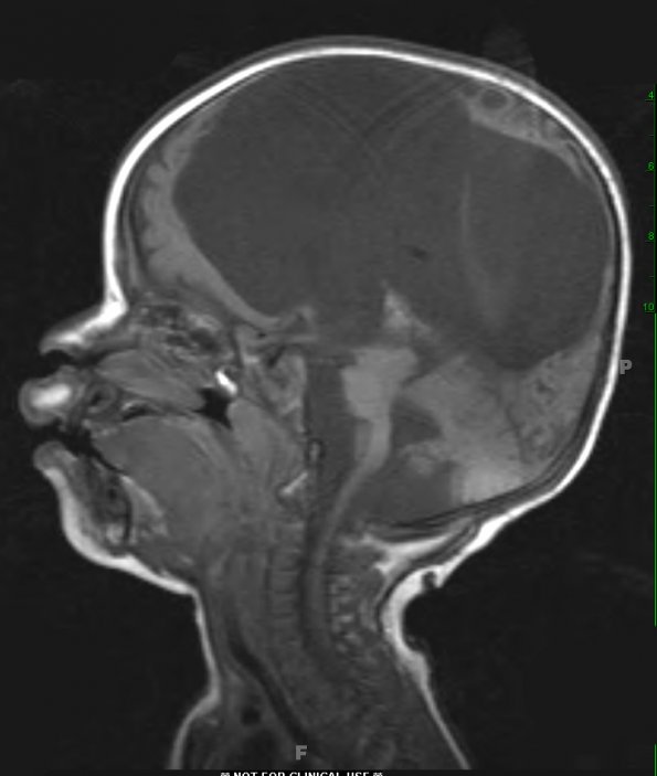 3A1 Ulegyria (Case 3) later than MRI 1 T1 3 - Copy