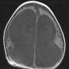 3A2 Ulegyria (Case 3) later than T1 1 - Copy