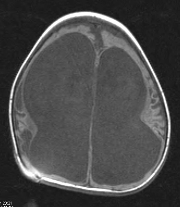 3A2 Ulegyria (Case 3) later than T1 1 - Copy