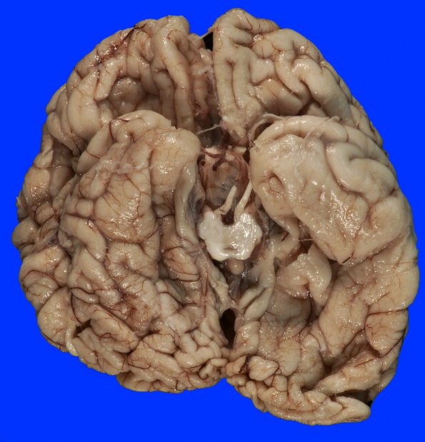 3B2 Ulegyria (Case 3) Gross 5