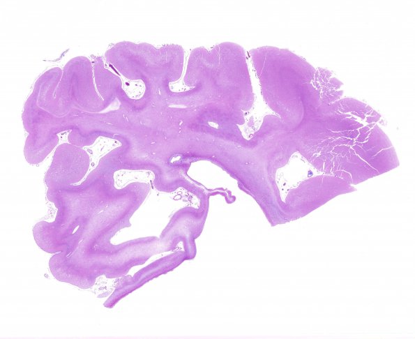 3D1 Ulegyria (Case 3) N10 1 H&E occipital lobe PMG WM