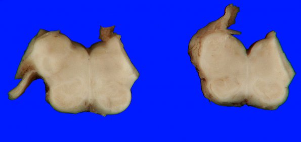 3G1 Ulegyria (Case 3) Gross 18