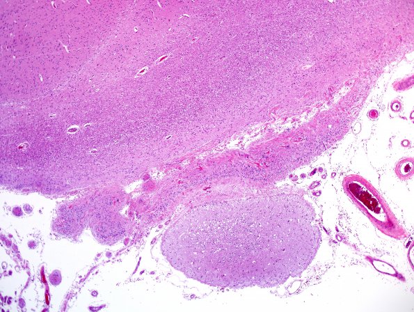 4B2 Ulegyria, 52yo, since birth (Case 4) N12 H&E 2