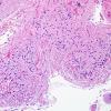 4B3 Ulegyria, 52yo, since birth (Case 4) N12 H&E 3