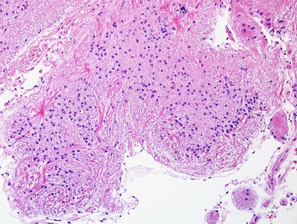 4B3 Ulegyria, 52yo, since birth (Case 4) N12 H&E 3