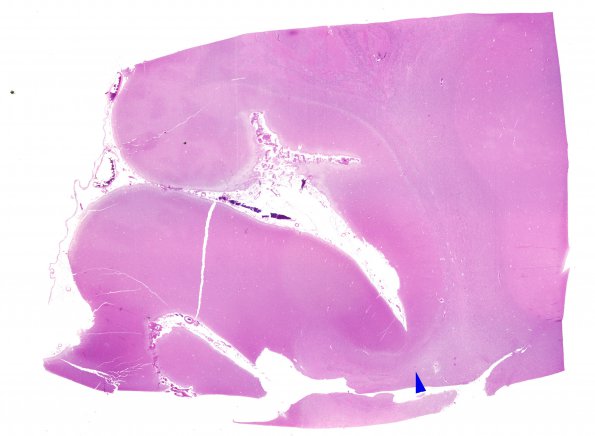 4C1 Ulegyria, 52yo, since birth (Case 4) N1 H&E WM 1 copy