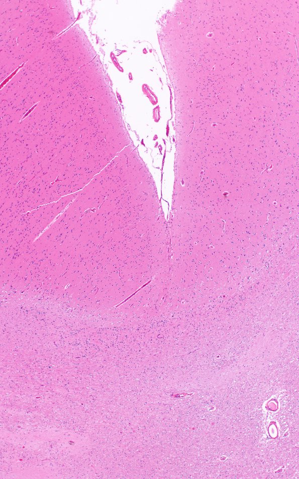 4C2 Ulegyria, 52yo, since birth (Case 4) N1 Same site H&E 3