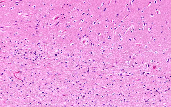 4C3 Ulegyria, 52yo, since birth (Case 4) N1 20X