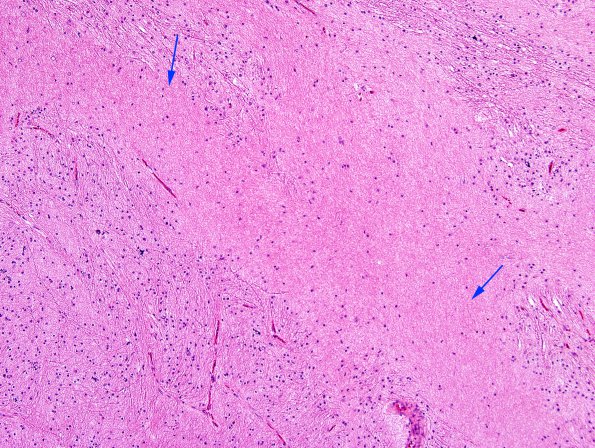 4C4 Ulegyria, 52yo, since birth (Case 4) N1 H&E White Matter 2 copy