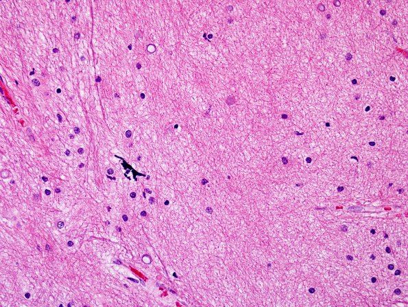 4C5 Ulegyria, 52yo, since birth (Case 4) N1 H&E White Matter 3