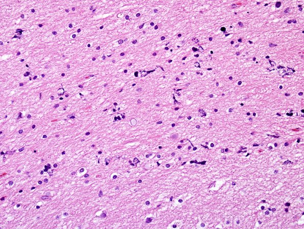 4C6 Ulegyria, 52yo, since birth (Case 4) N1 H&E Cortex & adjacent WM 3