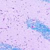 4D2 Ulegyria, 52yo, since birth (Case 4) N1 Same site LFB-PAS 1